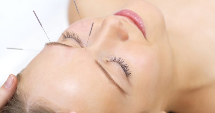 acupuntura