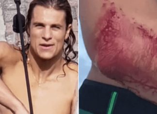 Surfista vai direto pro boteco ao invés de ir pro hospital após ser mordido por tubarão