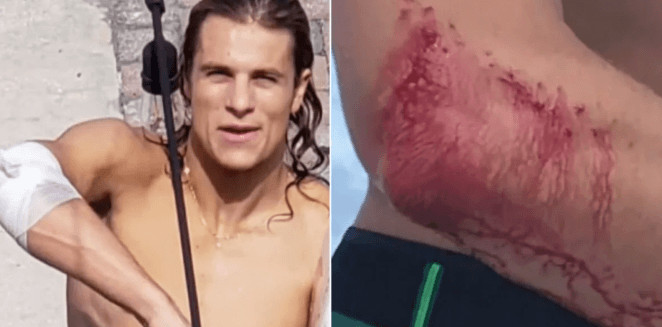Surfista vai direto pro boteco ao invés de ir pro hospital após ser mordido por tubarão