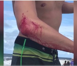 resilienciamag.com - Surfista vai direto pro boteco ao invés de ir pro hospital após ser mordido por tubarão