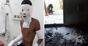 resilienciamag.com - Jovem teve partes do corpo queimados após resgatar 8 cães de um incêndio.