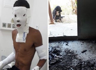 Jovem teve partes do corpo queimados após resgatar 8 cães de um incêndio.