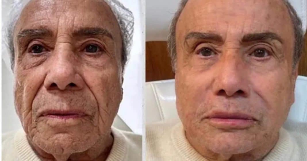 Aos 91 anos, ator Stênio Garcia faz harmonização facial e o resultado gerou polêmica.