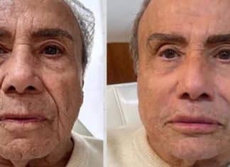 Aos 91 anos, ator Stênio Garcia faz harmonização facial e o resultado gerou polêmica.