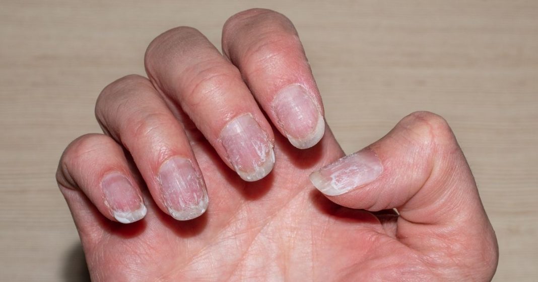 Homem descobre câncer após notar detalhe inusitado nas unhas