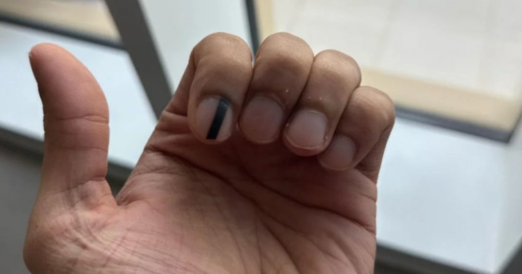Linha escura na unha? Entenda por que esse sinal pode ser mais sério do que parece