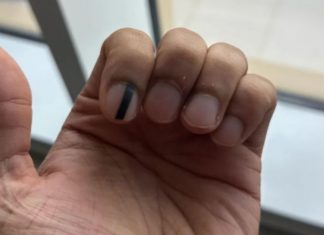 Linha escura na unha? Entenda por que esse sinal pode ser mais sério do que parece