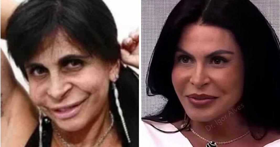 Gretchen surpreende com novo visual após harmonização facial e cirurgia nas pálpebras