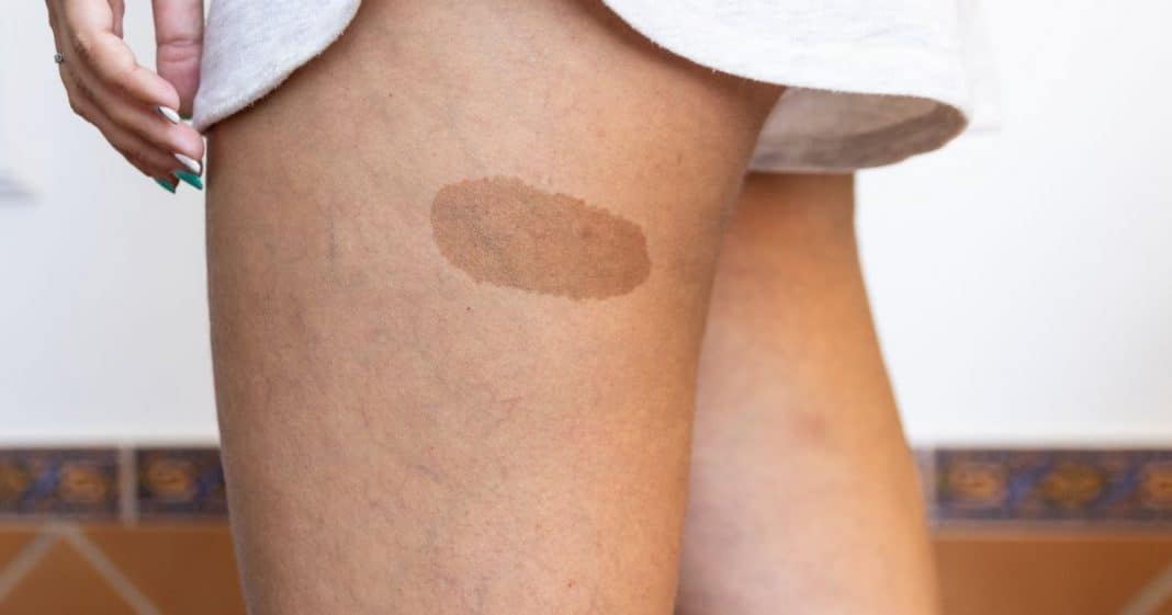 Marcas de nascença têm significado oculto? A espiritualidade revela o que ninguém te contou