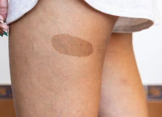 Marcas de nascença têm significado oculto? A espiritualidade revela o que ninguém te contou