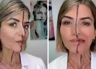 Médica faz teste e aplica botox em só um lado do rosto — o resultado impressionou os internautas