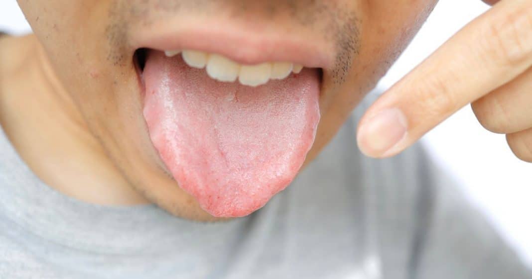 Língua branca não é só falta de higiene: O que esse sintoma pode esconder