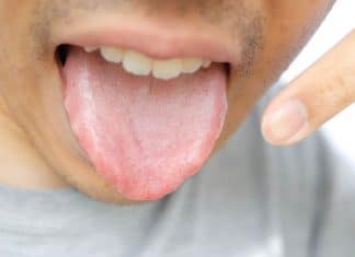 Língua branca não é só falta de higiene: O que esse sintoma pode esconder